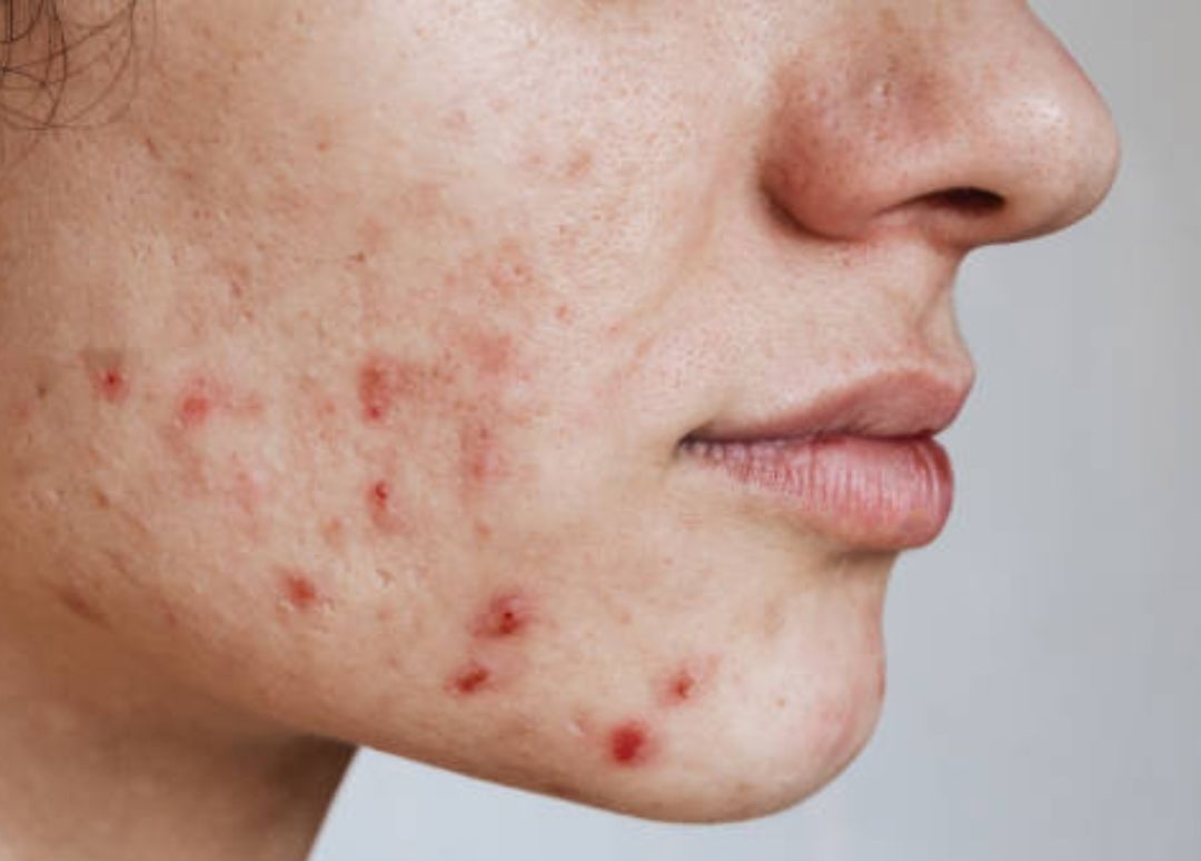 product education skincare making acne worse
