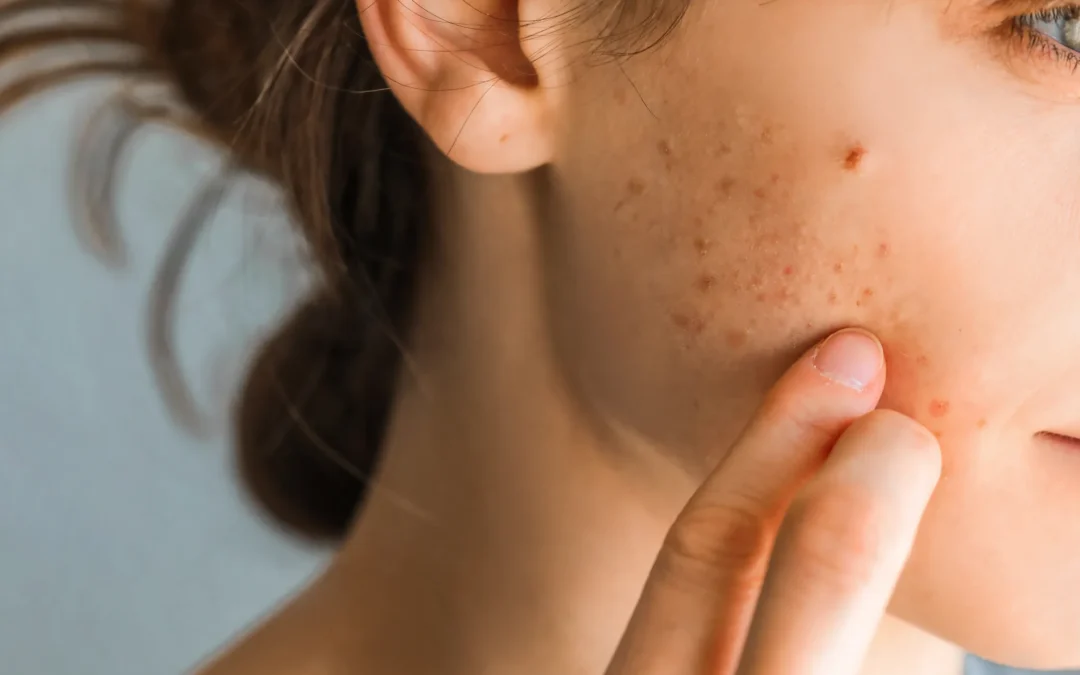 Why Acne Sometimes Gets Worse Before It Gets Better