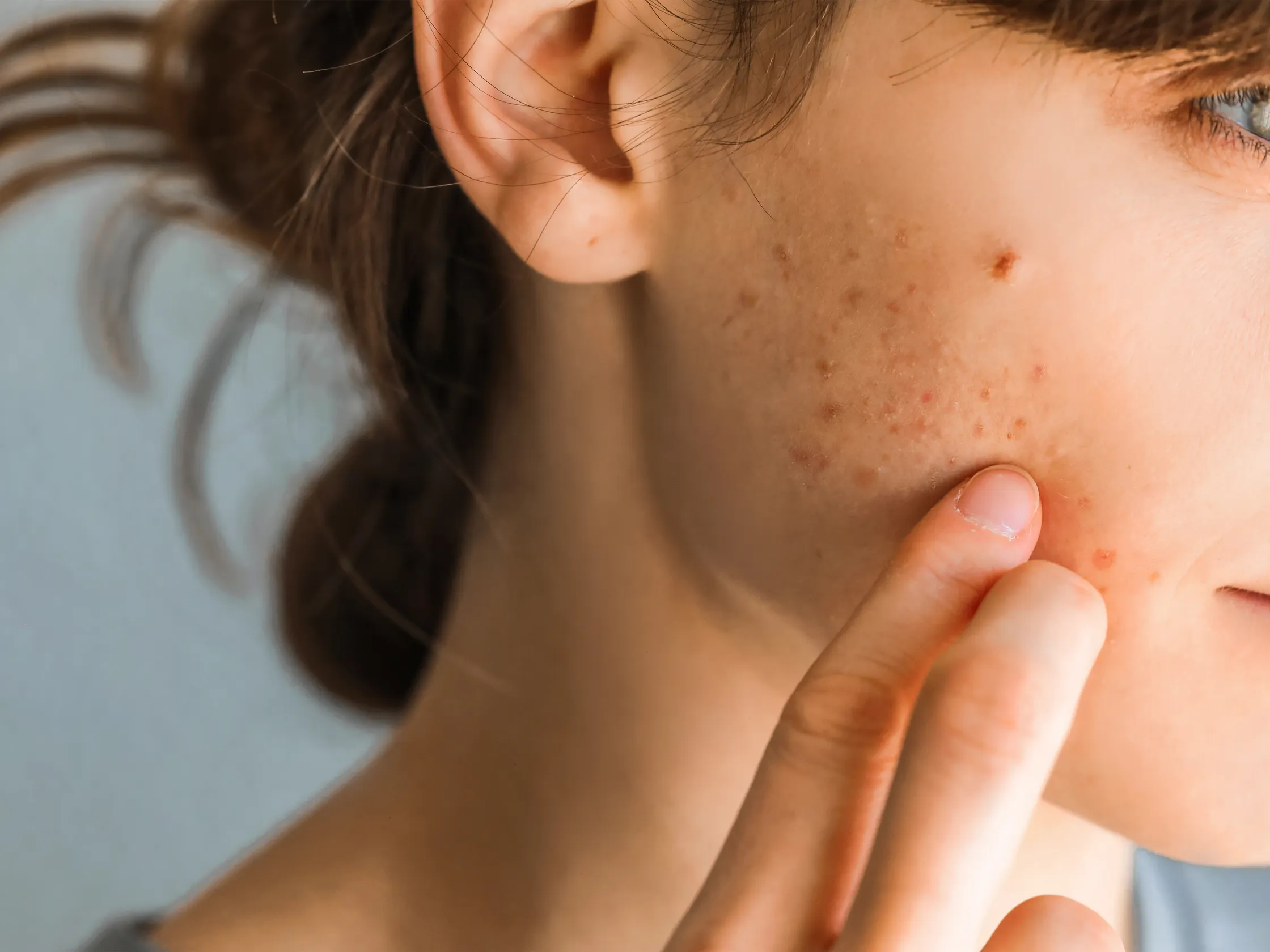 skin purging Why Acne Sometimes Gets Worse Before It Gets Better