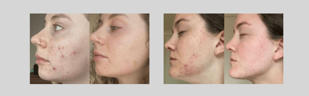 Why Acne Sometimes Gets Worse Before It Gets Better - AO2 Clear